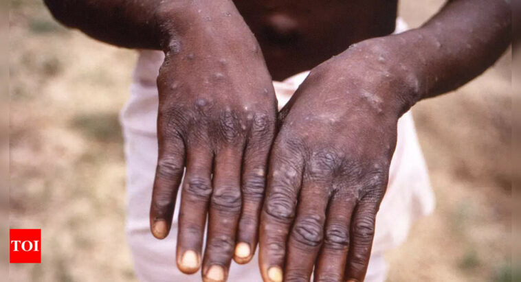 US warns monkeypox could mutate to resist antiviral drug