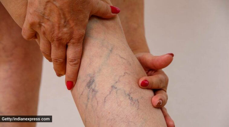 Effective tips to manage varicose veins naturally