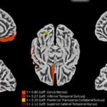 Study reveals main target of SARS-CoV-2 in brain and describes effects of virus on nervous system