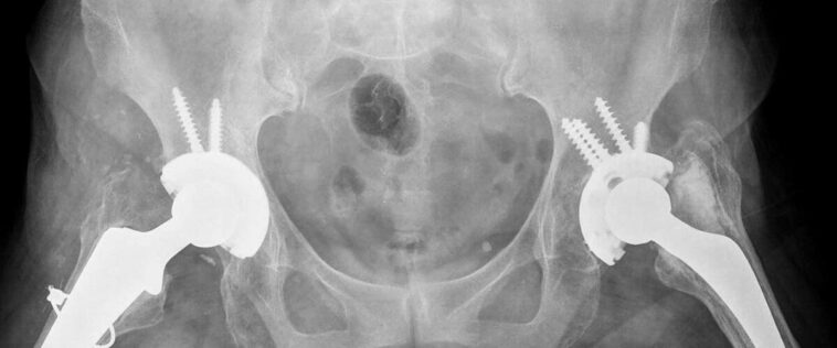 Why you need not fear the hip replacement surgery