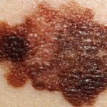 melanoma