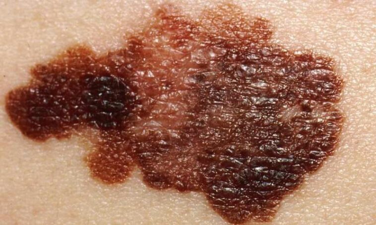 melanoma