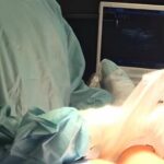 Ultrasound-guided surgery is quicker, less painful and more effective for treating early form of breast cancer