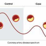 Digital marker for coronary artery disease built by researchers at Mount Sinai