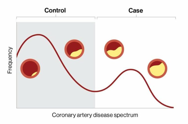 Digital marker for coronary artery disease built by researchers at Mount Sinai