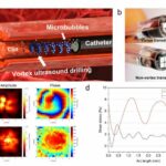 New tool uses ultrasound 'tornado' to break down blood clots