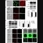 Downregulation of angulin-1/LSR induces malignancy in lung adenocarcinoma