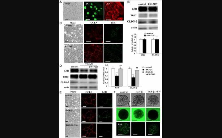 Downregulation of angulin-1/LSR induces malignancy in lung adenocarcinoma