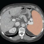 AI with volumetric thresholds facilitate opportunistic screening for splenomegaly