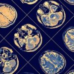 Microbiome: certain gut microbes may warn of Alzheimer's disease long before the first symptoms begin