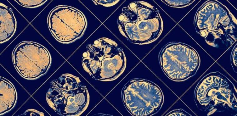 Microbiome: certain gut microbes may warn of Alzheimer's disease long before the first symptoms begin