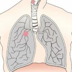 lung cancer