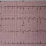 Virtual ward for atrial fibrillation patients could prevent thousands of hospital admissions per year