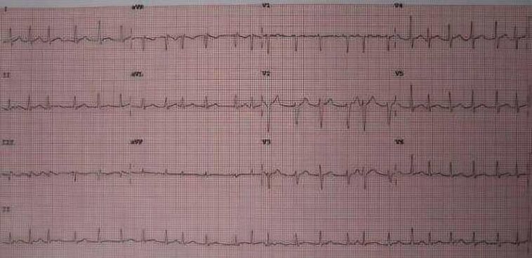 Virtual ward for atrial fibrillation patients could prevent thousands of hospital admissions per year