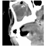 Atypical infections in chronic sinusitis: thinking outside the box