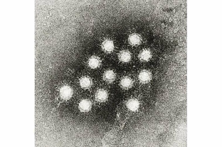 Hepatitis A