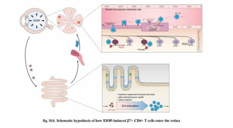 Association found between gut immune cells and eye damage from glaucoma