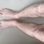 Raising awareness of Long Covid 'blue legs' symptom