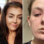 'Hell on Earth': Woman left with life-changing rash after topical steroid cream