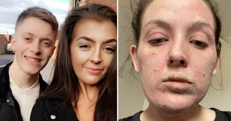 'Hell on Earth': Woman left with life-changing rash after topical steroid cream