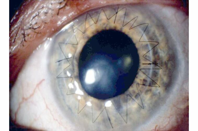 Study reveals untapped potential to increase eye donations needed for sight-restoring surgeries