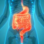 Beans beneficial for patients with history of colorectal neoplasia