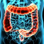 Patient error makes 1 in 10 home colon cancer tests unusable