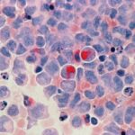 acute myeloid leukemia