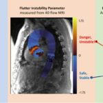 Unstable 'fluttering' predicts aortic aneurysm