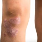 Biological agent trials for psoriasis rarely include patient images