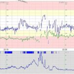 Large Finnish study finds that maternal pulse recording during childbirth prevents encephalopathy in newborn babies