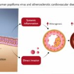 Women with HPV infection face higher risk of death from cardiovascular disease