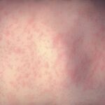 Measles is one of the deadliest and most contagious infectious diseases—and one of the most easily preventable