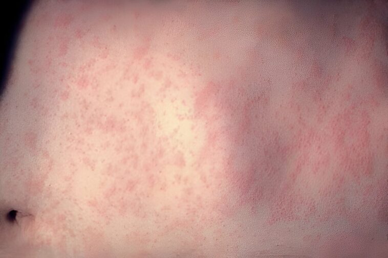 Measles is one of the deadliest and most contagious infectious diseases—and one of the most easily preventable