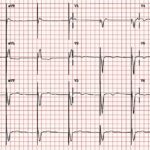 Pacemaker powered by light eliminates need for batteries and allows the heart to function more naturally—new research