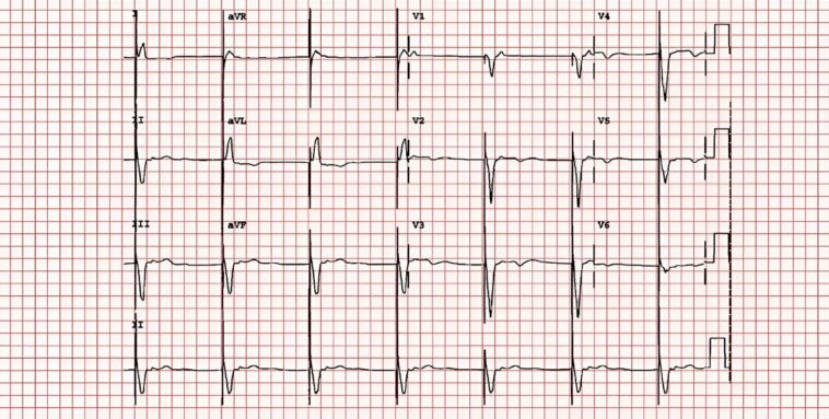 Pacemaker powered by light eliminates need for batteries and allows the heart to function more naturally—new research