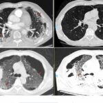 Simple blood test could predict risk of long-term COVID-19 lung problems