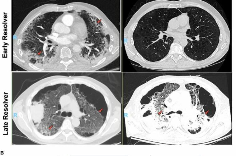 Simple blood test could predict risk of long-term COVID-19 lung problems