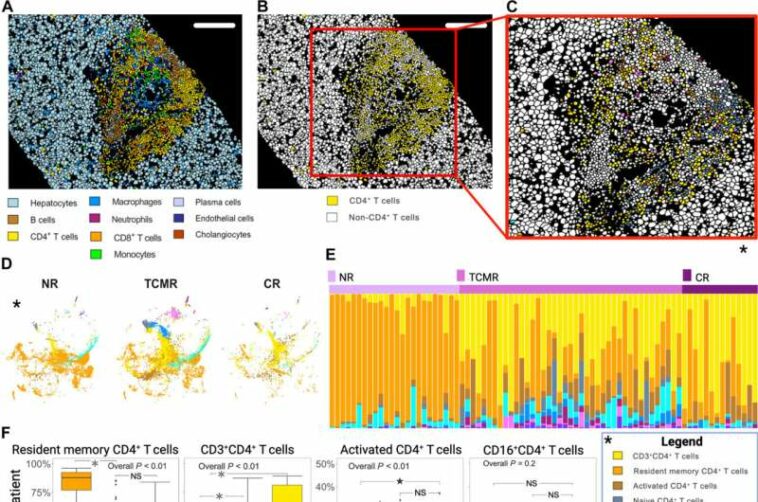 Researchers probe immune microenvironment to prevent pediatric liver transplant rejection