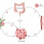 Tumor deposits in colorectal and gastric cancers