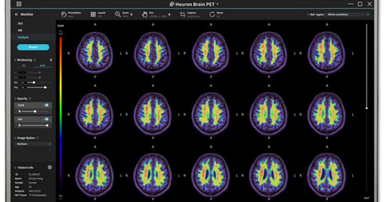 National University Hospital testing predictive AI for Alzheimer's diagnosis and more AI briefs