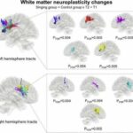 Singing rehabilitates speech production in post-stroke aphasia