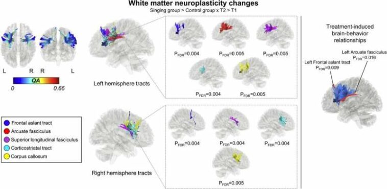 Singing rehabilitates speech production in post-stroke aphasia