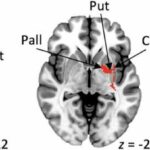 Research identifies brain network link to stuttering