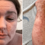 Courtney Celine Bray shows how eczema impacts her skin