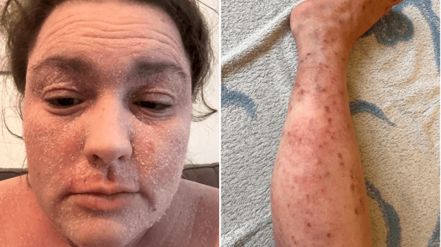 Courtney Celine Bray shows how eczema impacts her skin