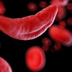 Sickle cell disease