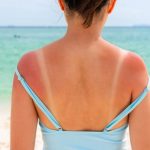 Sunburned skin on shoulder and back of a woman because of not using cream with sunscreen protection. Red skin sun burn after Sunbathing at the beach. Summer and holiday concept. Close up