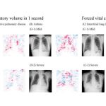 Innovative, highly accurate AI model can estimate lung function just by using chest x-rays