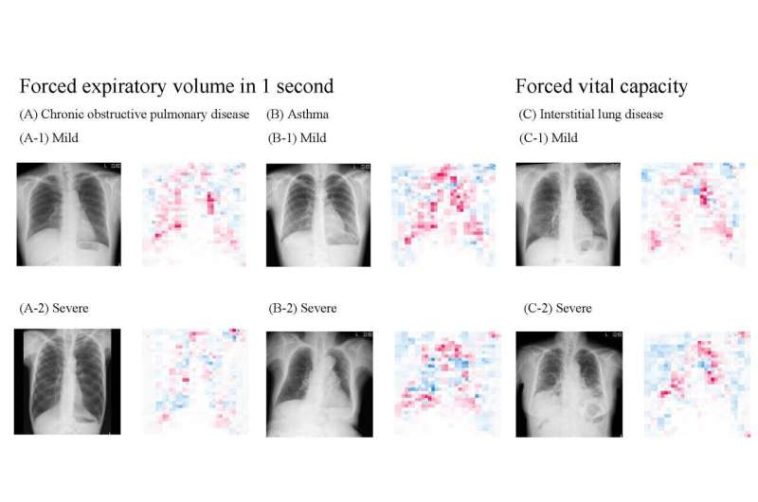 Innovative, highly accurate AI model can estimate lung function just by using chest x-rays